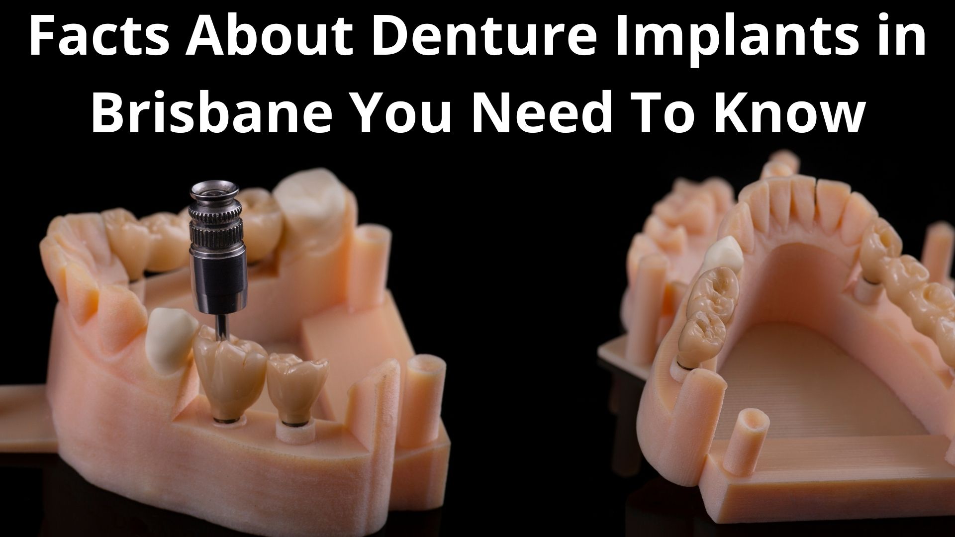 Facts About Denture Implants in Brisbane You Need To Know Before Getting One